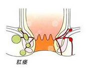 合肥治療肛瘺 合肥肛腸醫(yī)院 合肥肛門(mén)醫(yī)院哪家好