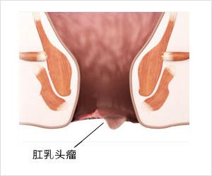 肛門乳頭，原因